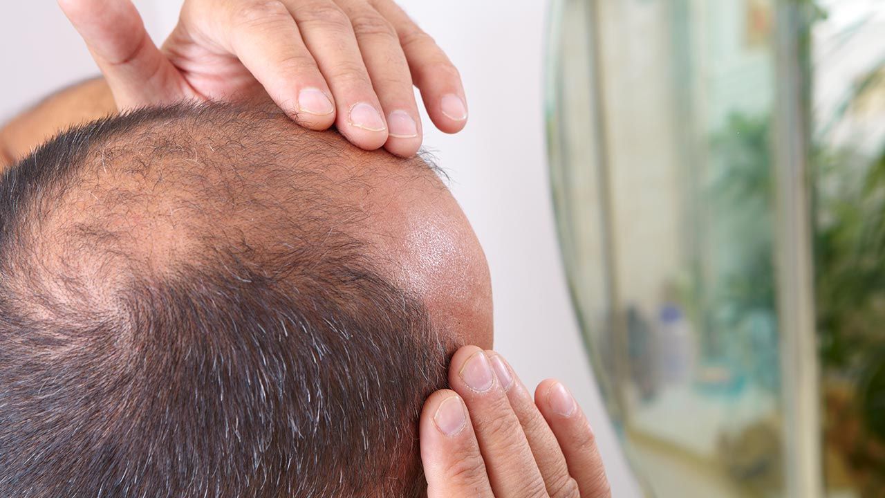 Naukowcy bliżej leczenia łysienia (fot. Shutterstock)